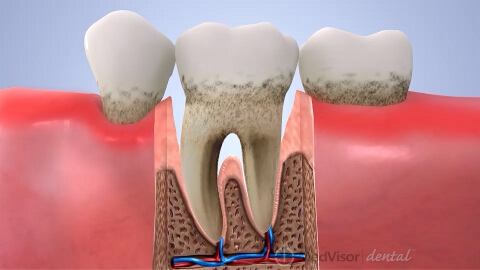 歯周病の進行の画像