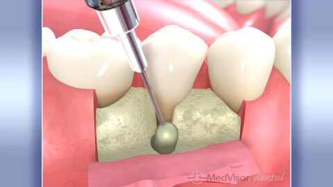 歯周組織再生（ゲル）の画像