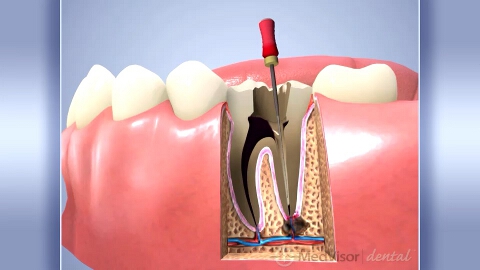 根管治療（臼歯）の画像