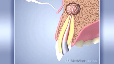 歯根端切除の画像