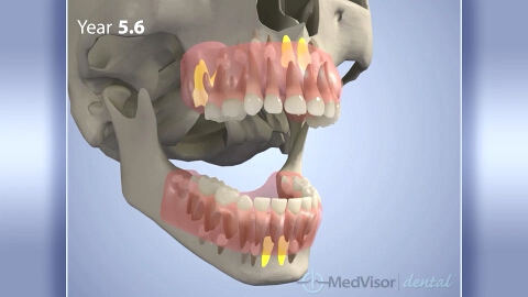 歯の萌出の画像
