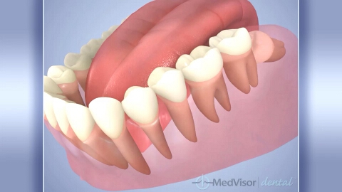 智歯による歯列不正の画像