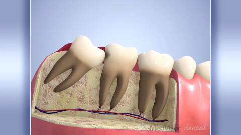 智歯の悪影響の画像